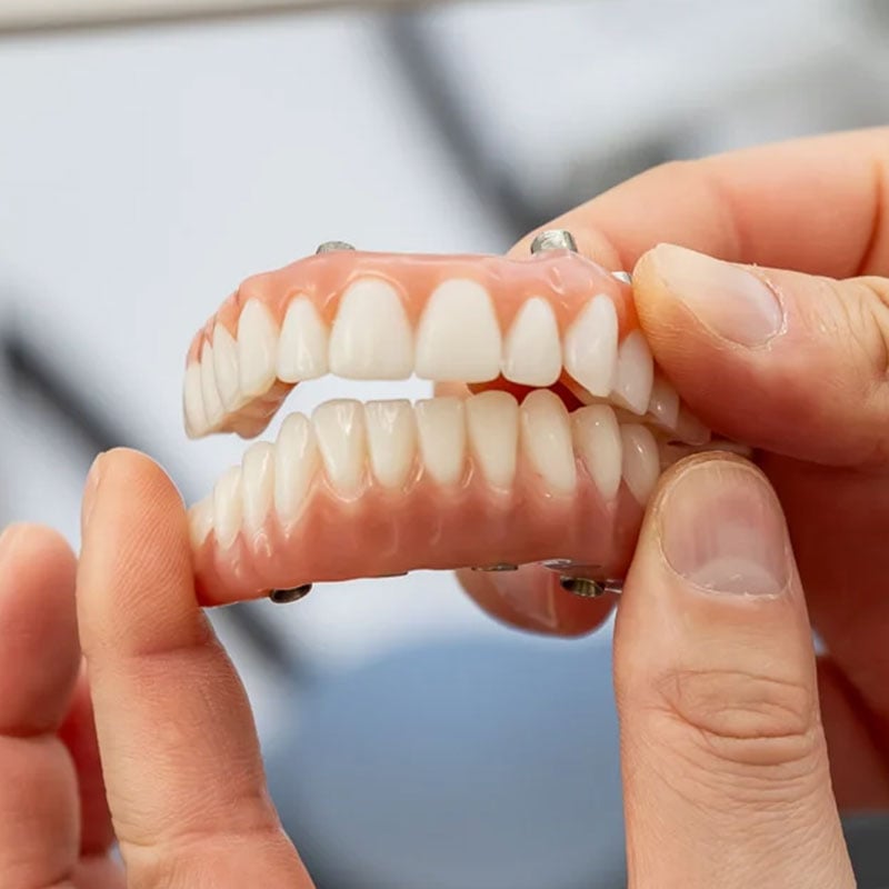 Full-arch fixed dental implants